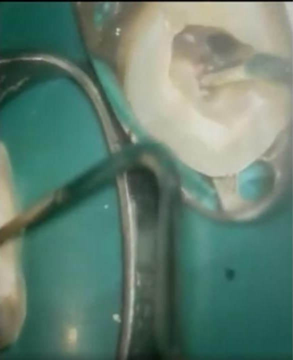 ラバーダム防湿を行った奥歯の根管を、顕微鏡下で処置しているところ