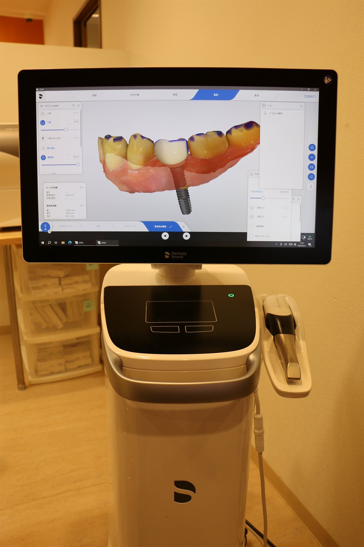 CERECの画面に表示されたインプラント上部構造の設計データ