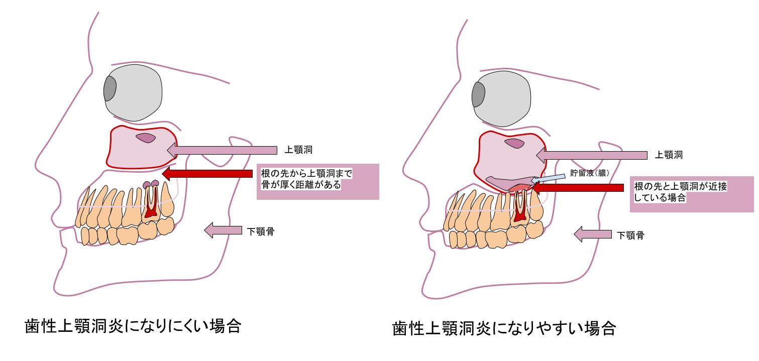 上顎の状態の比較図。左は根の先から上顎洞まで骨が厚く距離がある「なりにくい場合」、右は根の先と上顎洞が近接して貯留液がたまった「なりやすい場合」