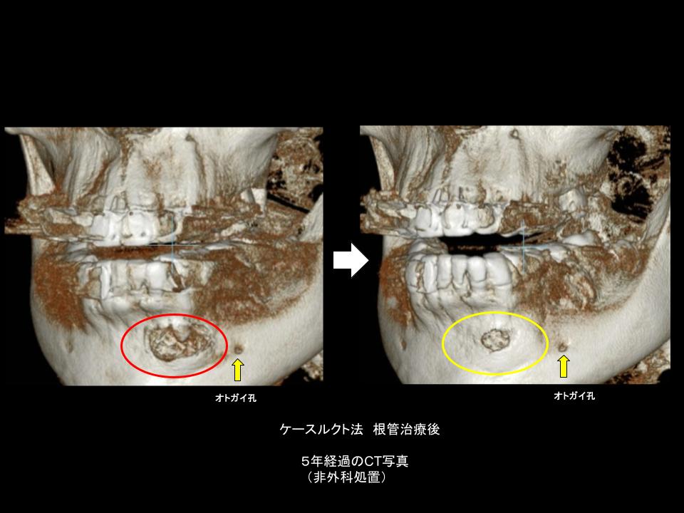 ケースルクト法による根管治療の前後を並べたレントゲン