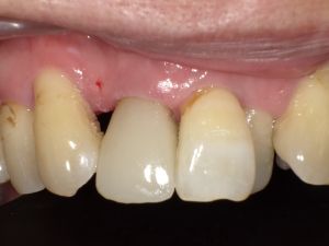完成したイーマックス冠を左上前歯に装着した口腔内写真