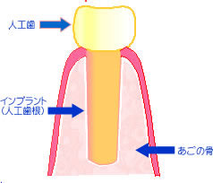 インプラント治療に不安を感じる患者のイメージイラスト