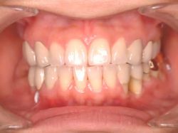 正面から見ても義歯が入っているとわからないミリングデンチャーの写真。18年6か月使用している状態