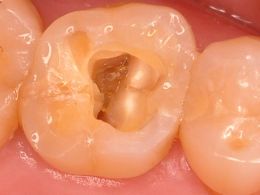 症例2の口腔内写真。歯の中の治療のために、咬む面に穴を開けたところ