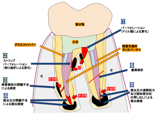 根管治療のトラブルの図