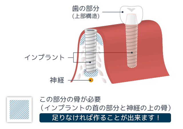 骨が足りない部分のインプラント治療イメージ図。骨が薄い・少ない部位でも、骨造成によって骨を作ることでインプラントが可能になることを示している