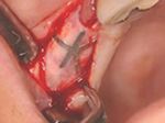 半年後、粘膜を開いてゴアテックス膜を取り除いている術中写真