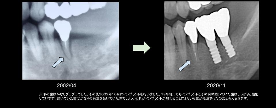 インプラント症例のレントゲン写真。奥にインプラントを埋入して動く歯の負担を軽減し、約18年後も動いていた歯が安定しインプラントも問題なく機能している