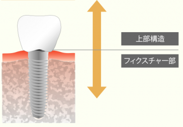 インプラント本体（フィクスチャー）と上部構造の構造図。根に相当する部分と人工歯に相当する部分の繋ぎ方の違いを示す