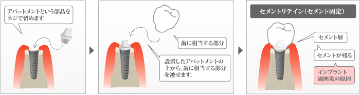 セメントリテイン（セメント固定）の模式図。上部構造をセメントで接着して固定する方法