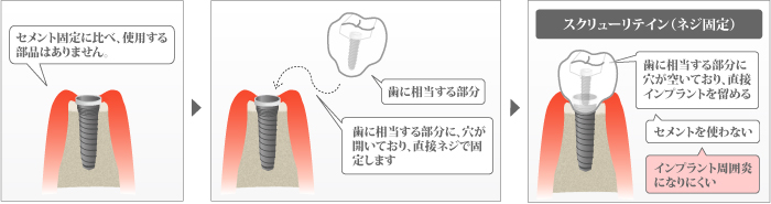スクリューリテイン（ネジ固定）の模式図。上部構造をチタン合金のネジで直接留めて固定する方法