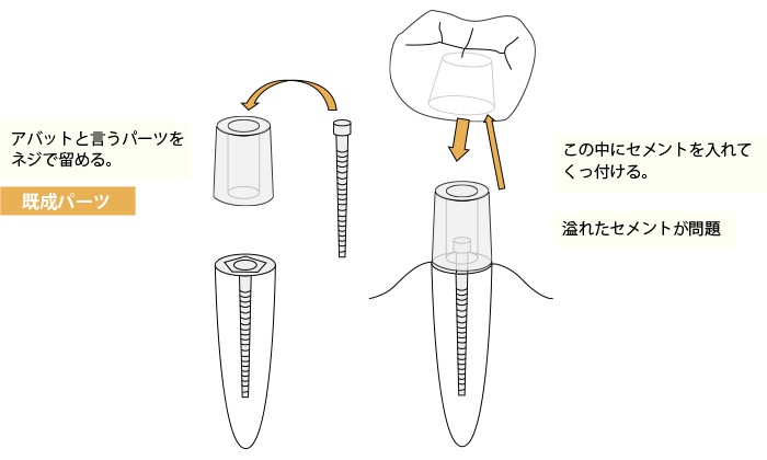 セメント固定のイメージ図。骨のラインと同等に埋め込まれたインプラントの接着部が歯肉の中にあり、流れ込んだセメントが残留して異物となる様子