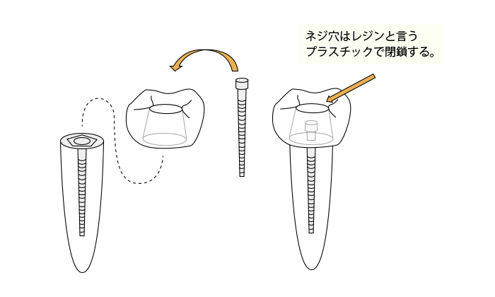 ネジ固定（スクリュー固定）のイメージ図。上部構造をフィクスチャーにチタン合金のネジで直接留め、セメントを一切使わない構造
