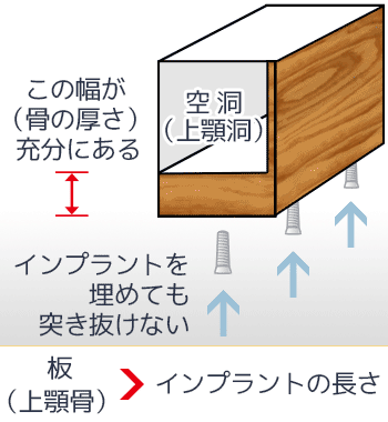 上顎奥歯の骨の厚みが充分にある状態の解説図。上顎洞（空洞）までの骨の幅が厚いため、インプラントを埋めても上顎洞を突き抜けない