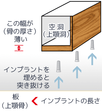 上顎奥歯の骨の厚みが薄い状態の解説図。上顎洞（空洞）までの骨の幅が薄いため、インプラントを埋めると上顎洞を突き抜けてしまう