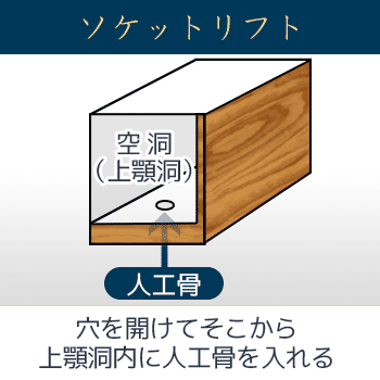 ソケットリフトの術式を示す解説図。インプラントを埋めるために開けた穴から上顎洞内に人工骨を挿入し、上顎洞底を押し上げる