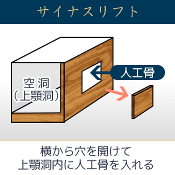 サイナスリフトの術式を示す解説図。横（側方）の骨に窓を開けて、上顎洞内に人工骨を入れる