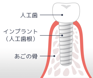 インプラントの構造図。インプラント本体部分と歯に相当する部分（上部構造）に分かれており、上側のパーツAと下側のパーツBで構成される様子を示した図