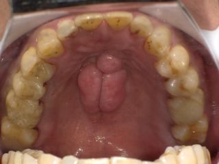 口蓋隆起の口腔内写真。上あごの真ん中（口蓋）に骨が帯状に盛り上がっている
