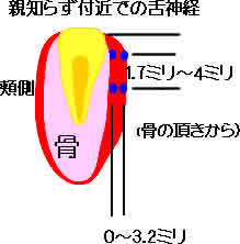 親知らず後方を通る舌神経の位置を示す模式図。抜歯時の切開ラインと舌神経の関係