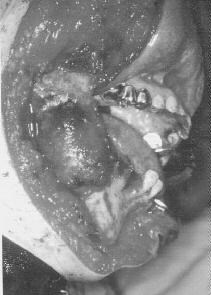 下顎骨悪性腫瘍の手術写真。腫瘍部分を切除し、腸骨を移植して再建した症例