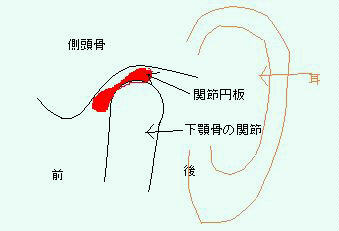 顎関節の構造を示す解説図。側頭骨と下顎骨の間にある関節円板（赤色で表示）が前方にずれている様子と、耳・前後の位置関係を示している