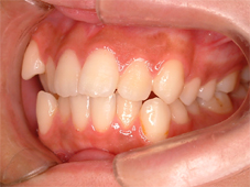 矯正治療前の口腔内写真（右側面観）。歯が重なって生え、咬み合わせが乱れている状態