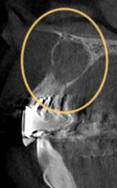 CTの断面画像。根の先に大きな空洞（黒い透過像）が確認でき、周囲の骨は残っている