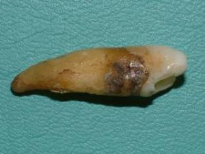 歯周病で抜歯した歯。歯の根に黒い歯石が付着しており、これが歯肉の下に隠れていた状態を示している